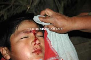 Un niño de tan solo 10 años fue impactado por un disparo de perdigón cerca de uno de sus ojos